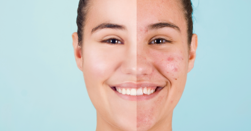 Benefits of Probiotics for Acne Prevention