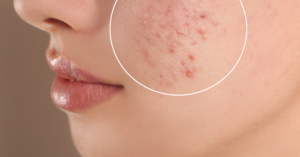 Benefits of Probiotics for Acne Prevention