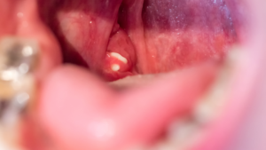 popping hidden tonsil stones