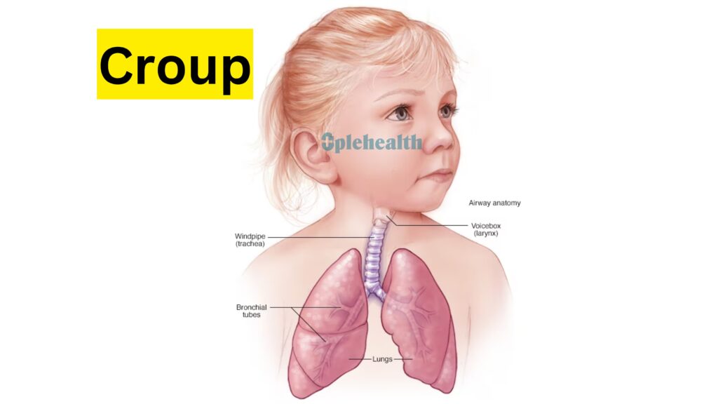 is croup contagious