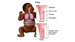 is croup contagious