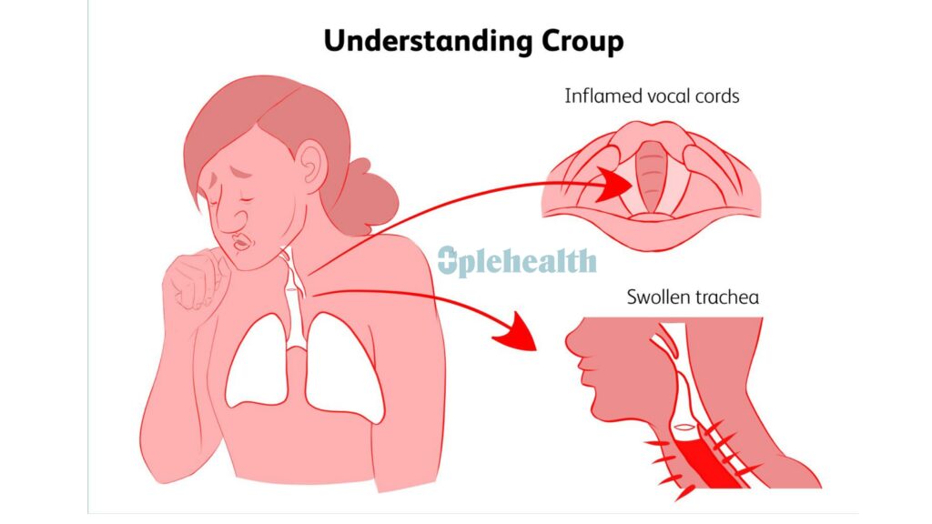 is croup contagious