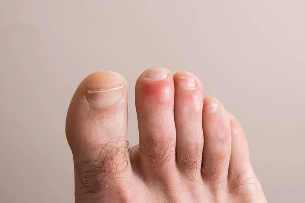 How to Get Rid of Chilblains Quickly