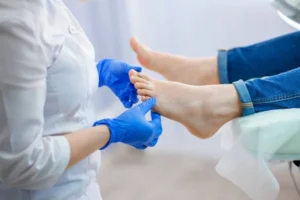 How to Get Rid of Chilblains Quickly