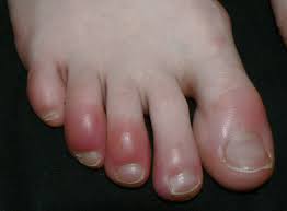 How to Get Rid of Chilblains Quickly