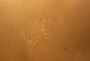 Vitamin deficiency small white spots on skin