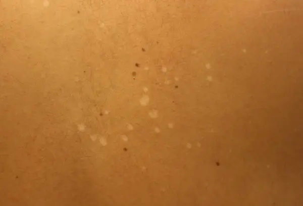 Vitamin deficiency small white spots on skin