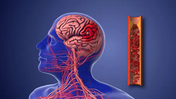 bell's palsy vs stroke