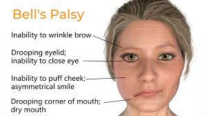 bell's palsy vs stroke