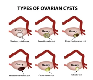 what size of ovarian cyst is dangerous