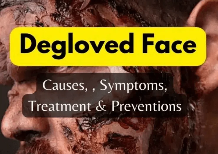 degloved face