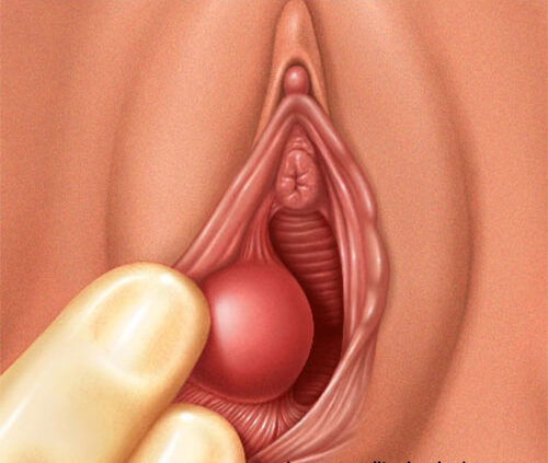 labial sebaceous cyst