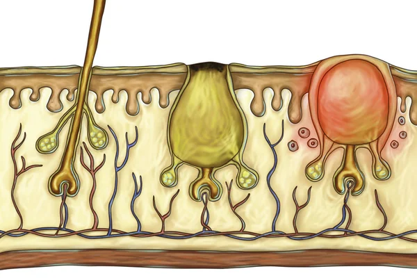 labial sebaceous cyst 