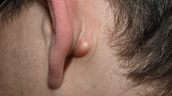 lump behind ear