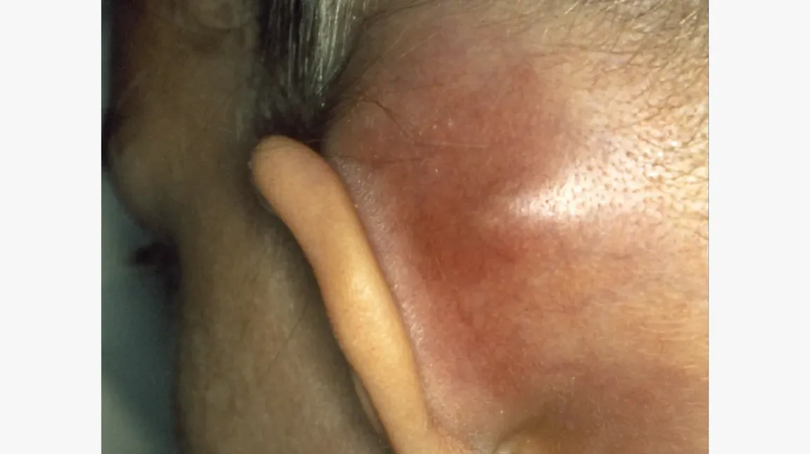 lump behind ear